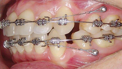 Мини-имплантаты ортодонтия