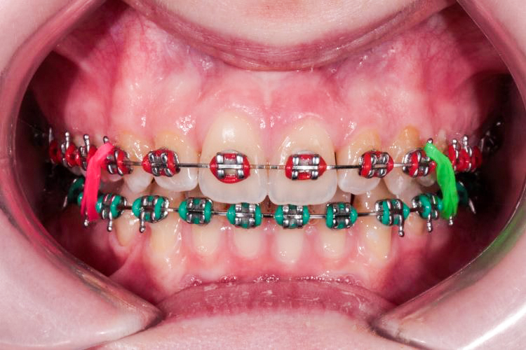 Цветная ортодонтическая тяга