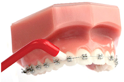 Чистка зубов с брекетами монопучковой щеткой